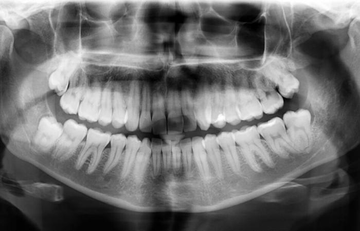 Investigadores japoneses presentan un tratamiento para que los dientes vuelvan a crecer