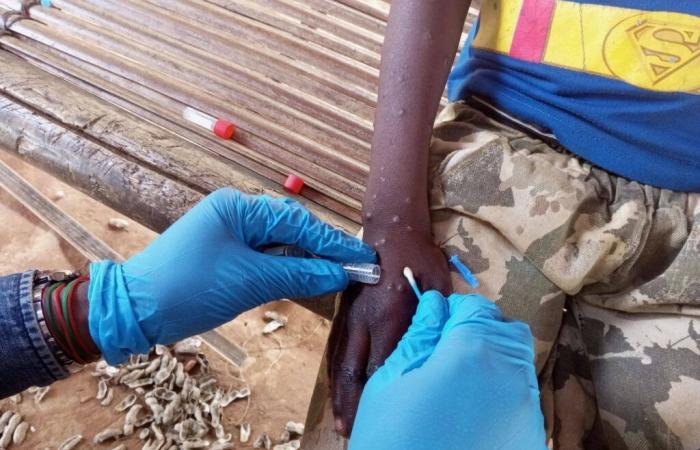 OMS preocupada por situación de Mpox en África | APAnoticias