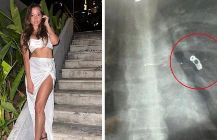 Una influencer acude al médico por un resfriado y descubre un objeto aterrador… en sus pulmones