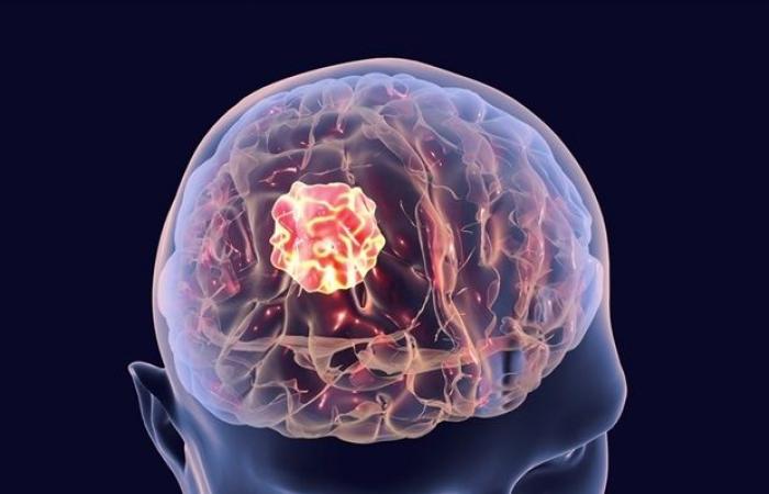 Un estudio identifica los mejores métodos de imagen para evaluar la respuesta del tumor cerebral en pacientes con melanoma