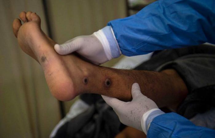 Nueva variante de mpox en Francia: ¿cuáles son los riesgos?