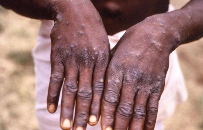 Hombre de 27 años: Sierra Leona informa del primer caso confirmado de mpox