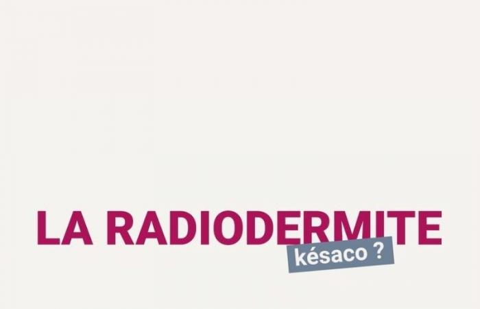 La Minute du Dr RoseUp – Radiodermatitis, kesako? – Asociación RoseUp %