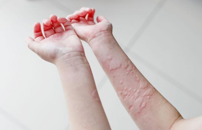 Alergia al frío o urticaria: causas, síntomas y cómo afrontar el invierno