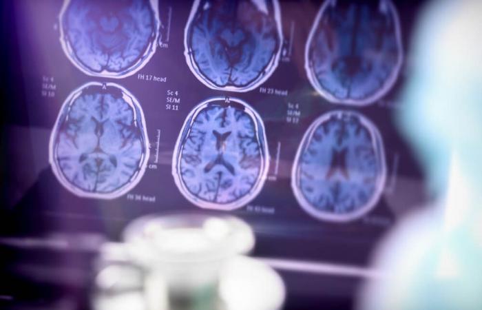 4 millones de euros para avanzar en la investigación del Alzheimer