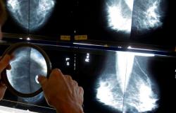 La Sociedad Canadiense del Cáncer pide realizar pruebas de detección del cáncer de mama a partir de los 40 años