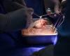 Muere el portador de un riñón de cerdo genéticamente modificado