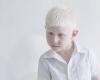 Hoy es el Día Internacional de Concientización sobre el Albinismo