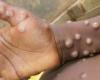 MPOX golpea duramente a los niños de Burundi