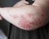 Zasocitinib, otro inhibidor de Tyk2 para tratar la psoriasis oral