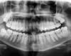 Investigadores japoneses presentan un tratamiento para que los dientes vuelvan a crecer